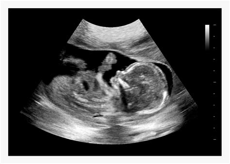 fake ultrasound pictures|More.